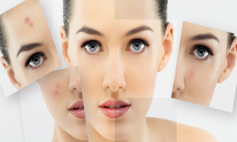 Sivilce lekelerine doğal çözüm