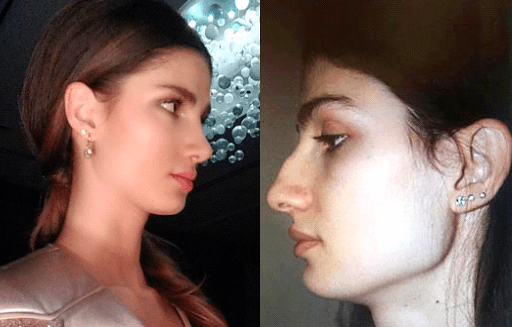 Best Model Of Turkey 2016 Birincisi Gizem Kayalı Burnunu Yaptırdı