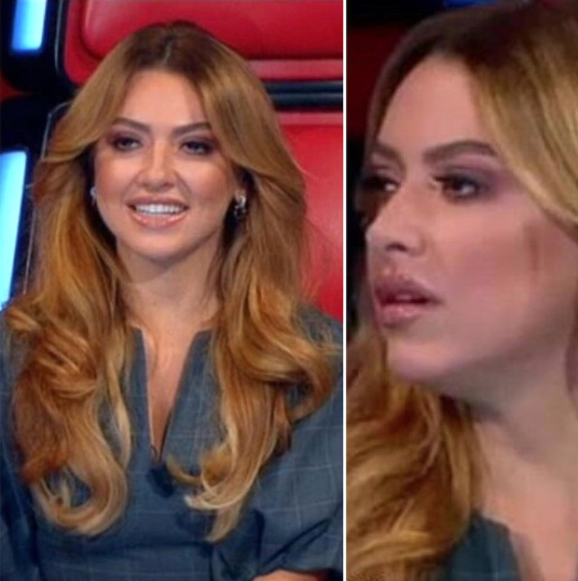 Hadise Yüzündeki Değişiklik İle Gündeme Geldi