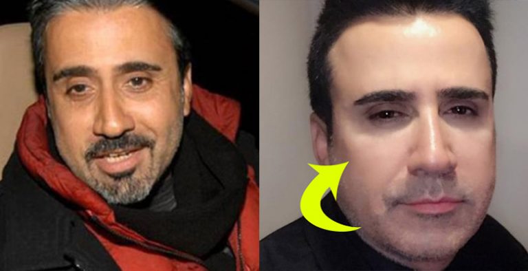 Ucuz Botox Mağduru Emrah!