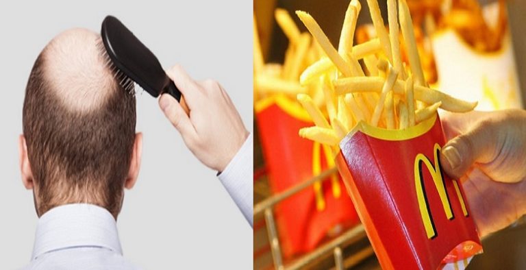 McDonald's Patatesi Yemek Kelliğe Çözüm Oluyor mu?