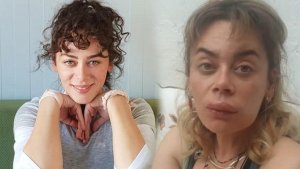 Demet Evgar’ın Dudağına Botoks mu Yaptırdı?