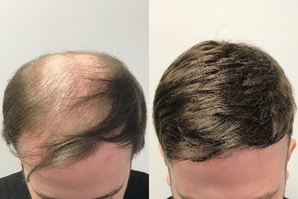 Saç Protez Merkezleri