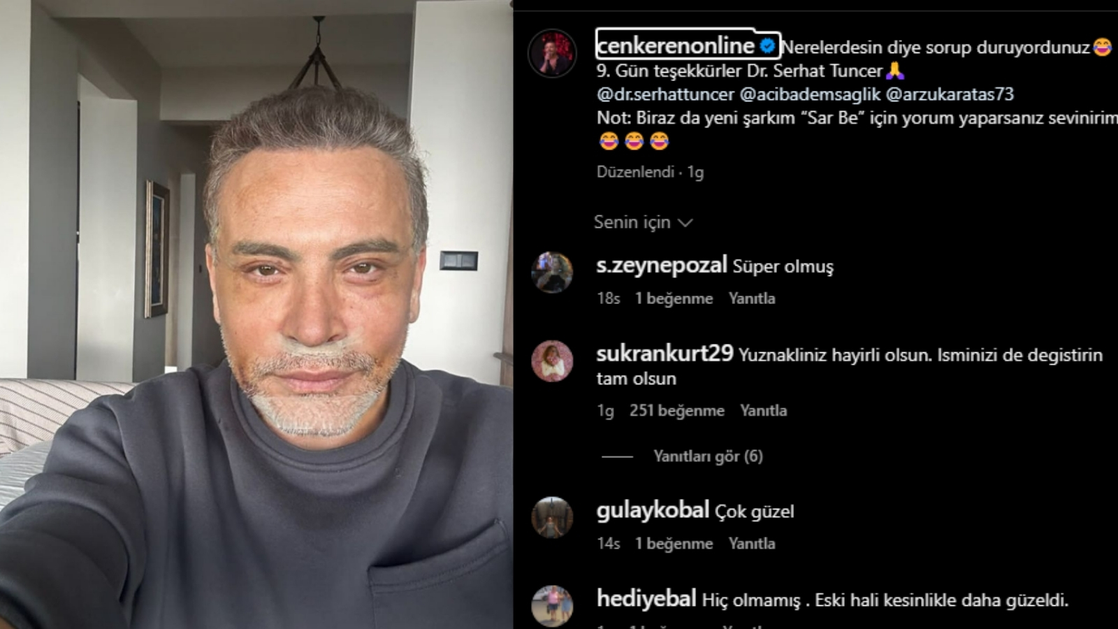 58 yaşındaki Cenk Eren Yüzünü Gerdirdi! İşte Yeni Hali!