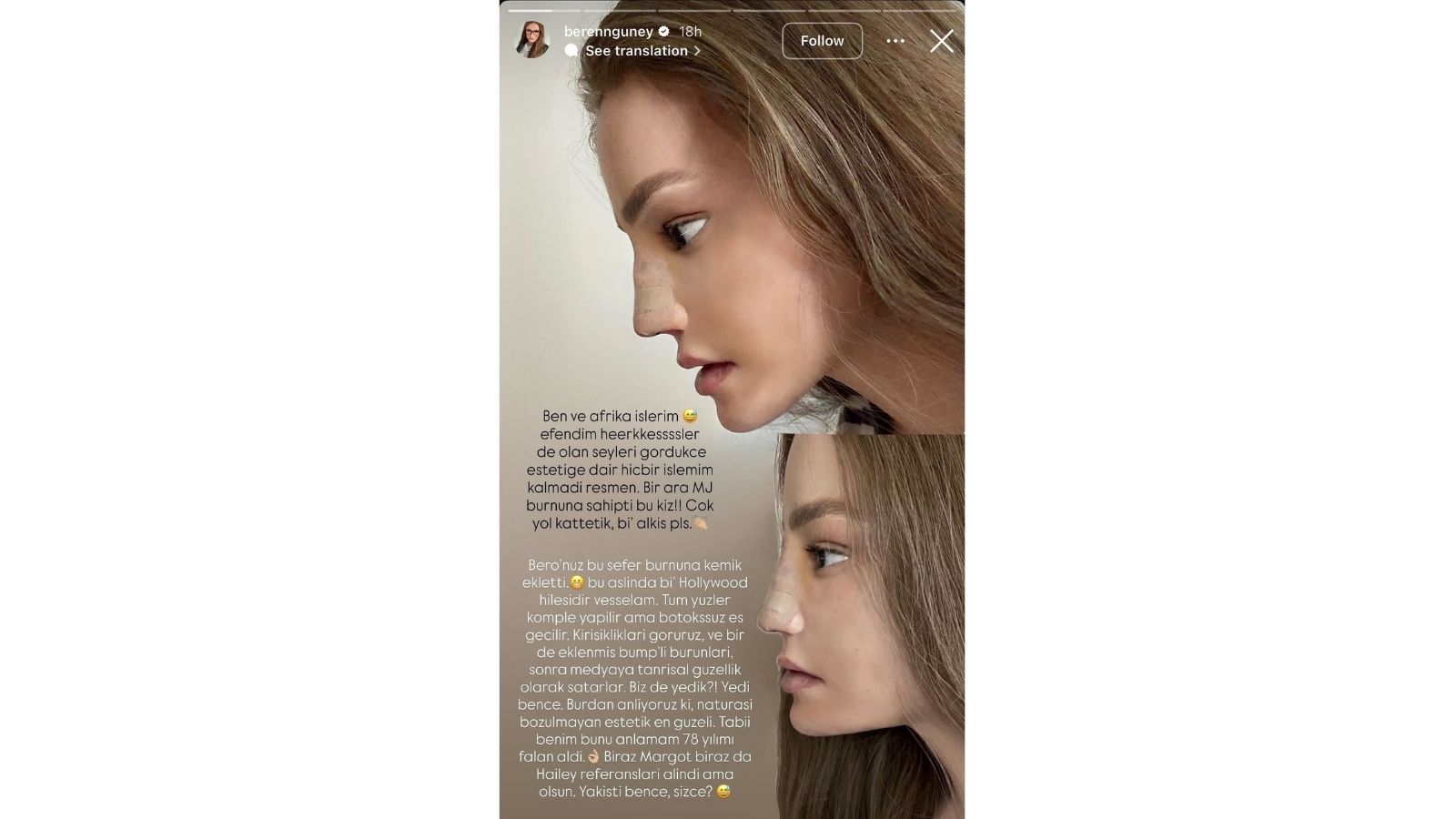 Beren Güney Burnuna Kemer Ekletti, 'Hollywood Hilesi' Dedi!