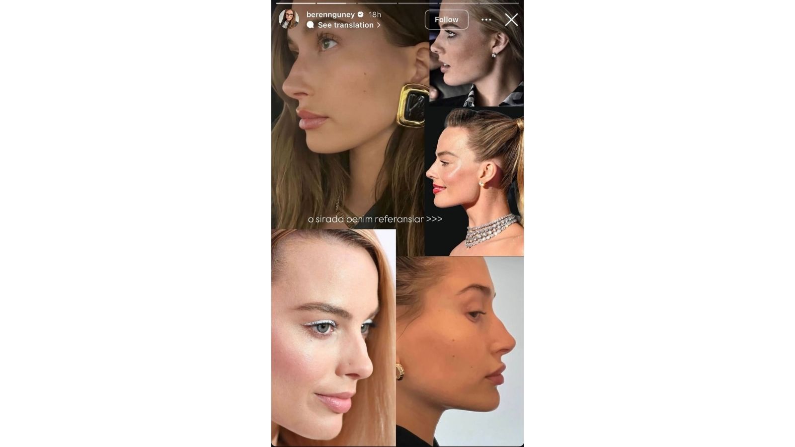 Beren Güney Burnuna Kemer Ekletti, 'Hollywood Hilesi' Dedi!