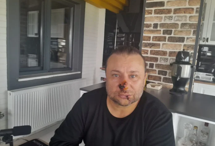 Onur Akay Yoğun Bakımda