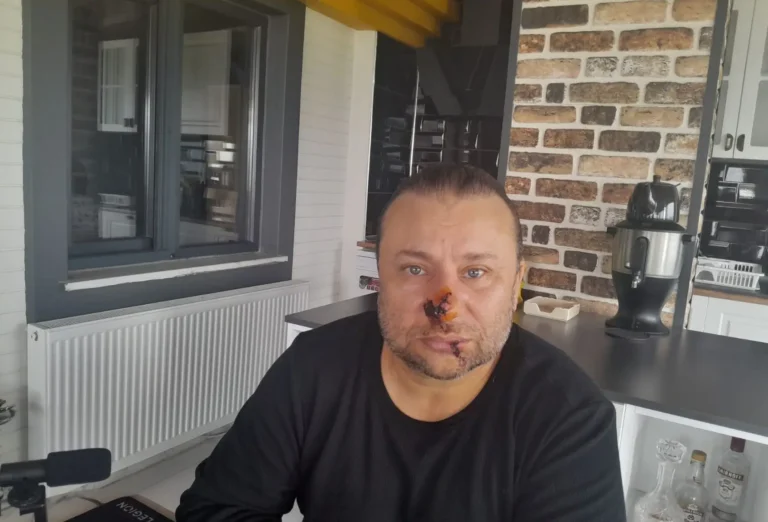 Pitbull Saldırısına Uğrayan Onur Akay Yoğun Bakımda