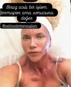 Dermapen Nedir?
